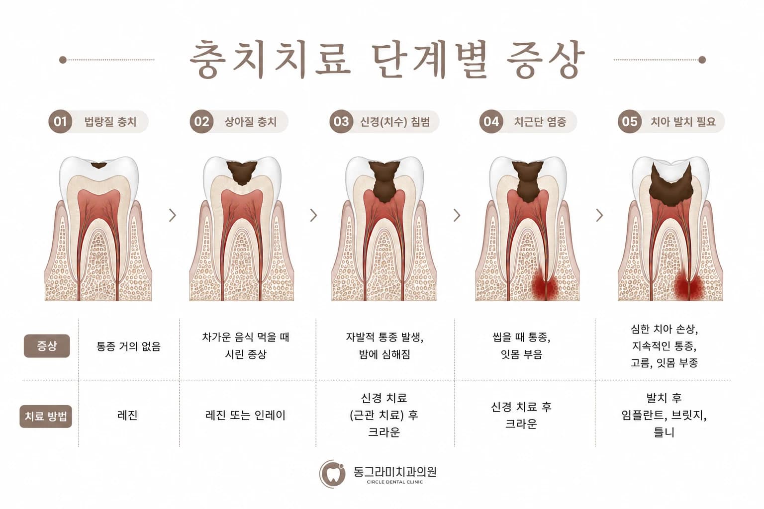 충치 진행 5단계 도해. 법랑질 충치, 상아질 충치, 신경(치수) 침범, 치근단 염증, 치아 발치 필요 순으로 단면 그림과 함께 단계별 증상과 치료 방법을 정리했다.