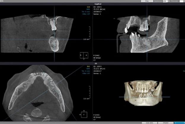 치료 계획에 사용한 3D CT 화면. 단면 세 방향과 입체 재구성 영상이 함께 표시되어 있다.