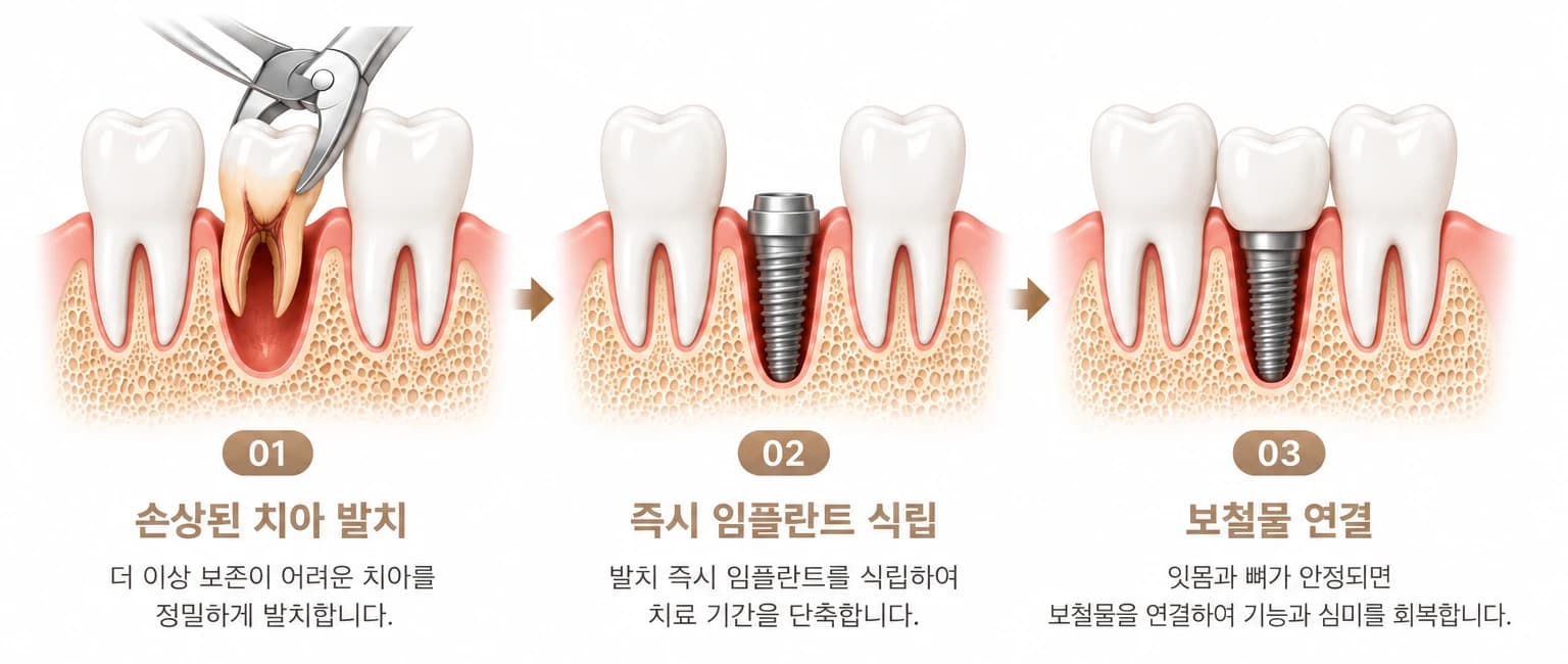 발치 후 즉시 식립 세 단계 — 01 손상된 치아 발치, 02 즉시 임플란트 식립, 03 보철물 연결